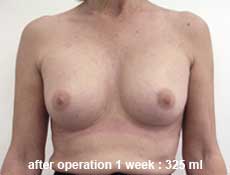 plastic-surgery-breast-augmentation 